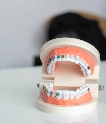 Invisalign Vs Braces