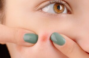 Why Addressing Underlying Health Problems Is Key To Acne Control
